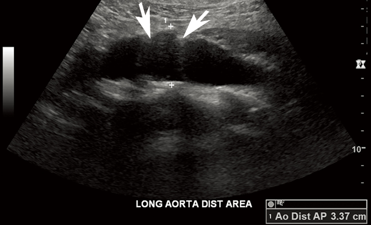 Abdominal Aortic Aneurysm Screening Concepts And Controversies