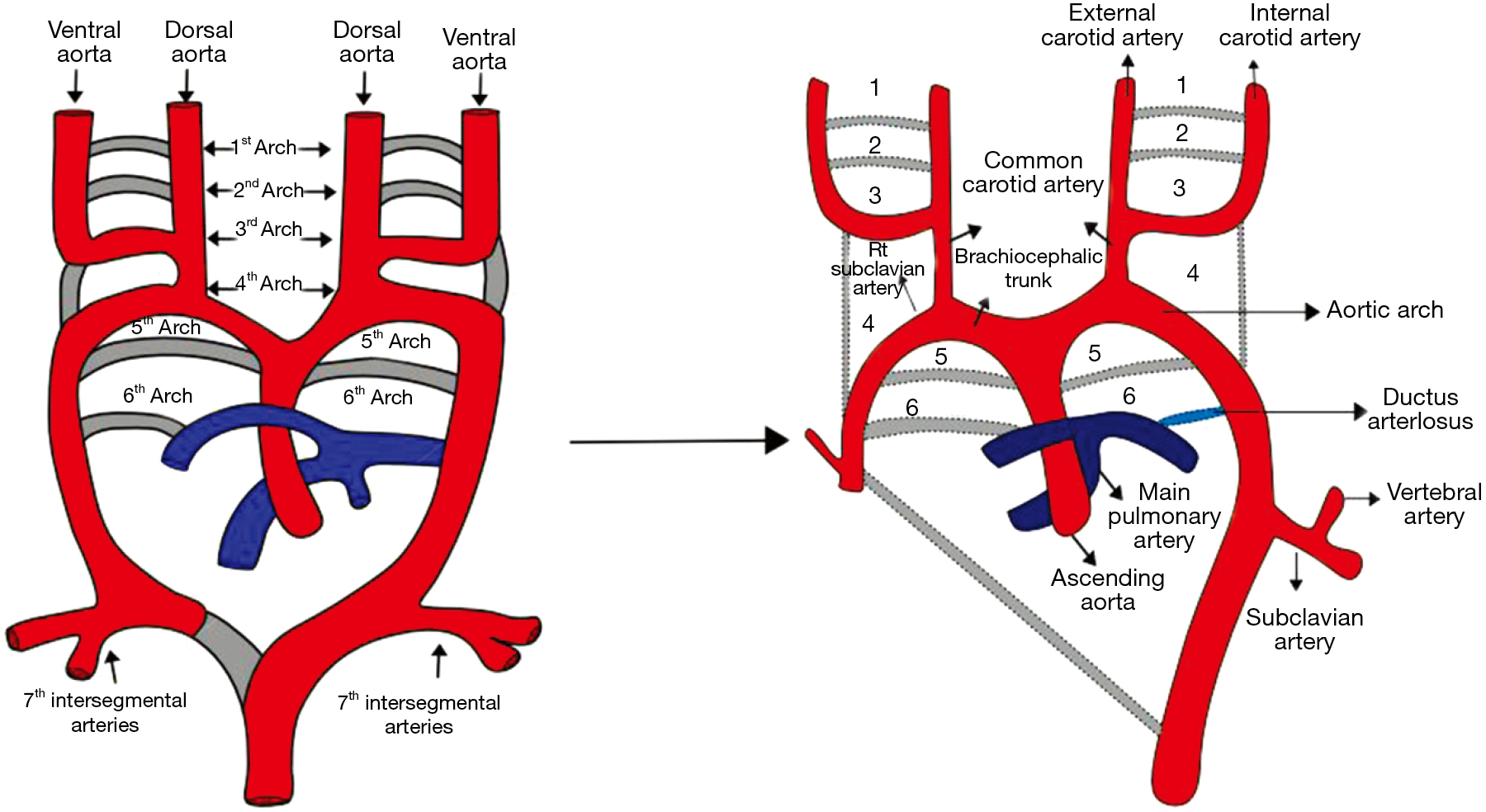 Congenital Anomalies Of The Aortic Arch Priya Cardiovascular