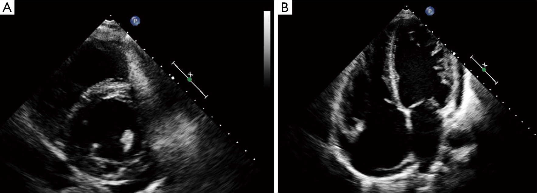 Left ventricular noncompaction cardiomyopathy - Shemisa - Cardiovascular Diagnosis and Therapy