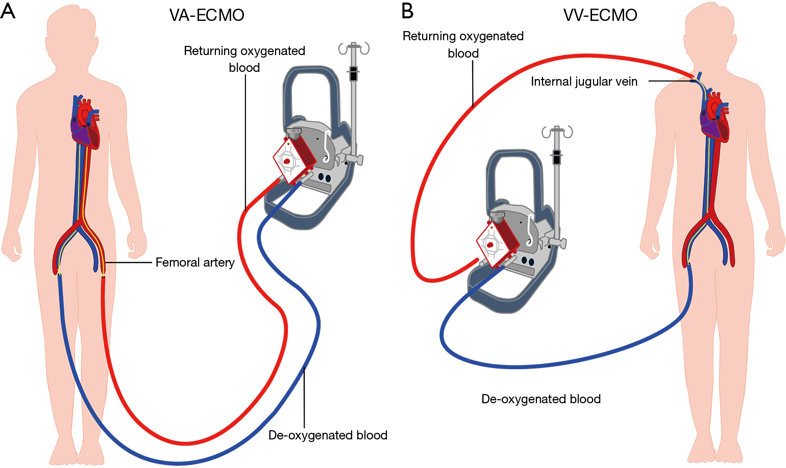 Management of vascular complications of extra-corporeal membrane ...